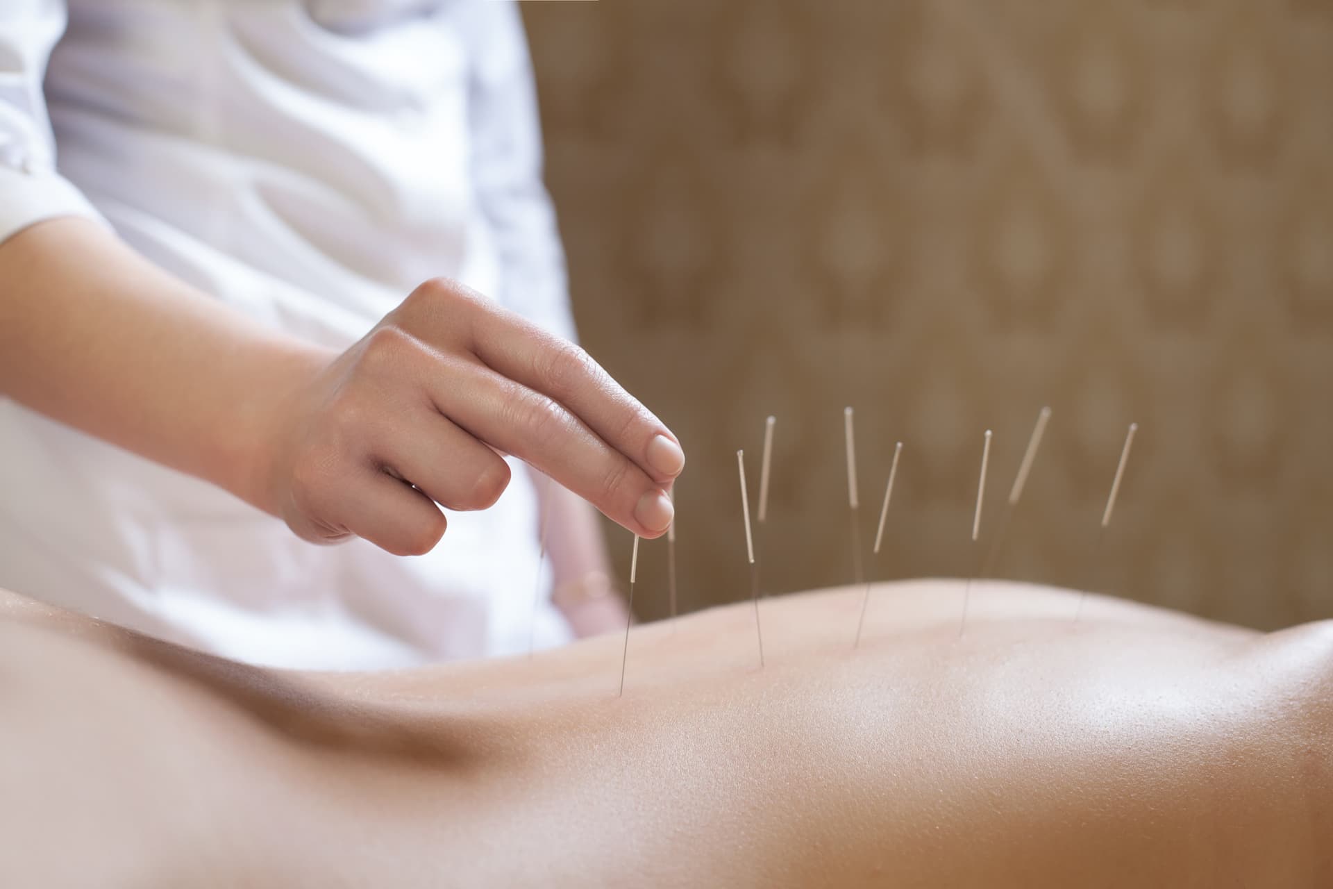 Cuida tu salud con acupuntura en Milladoiro